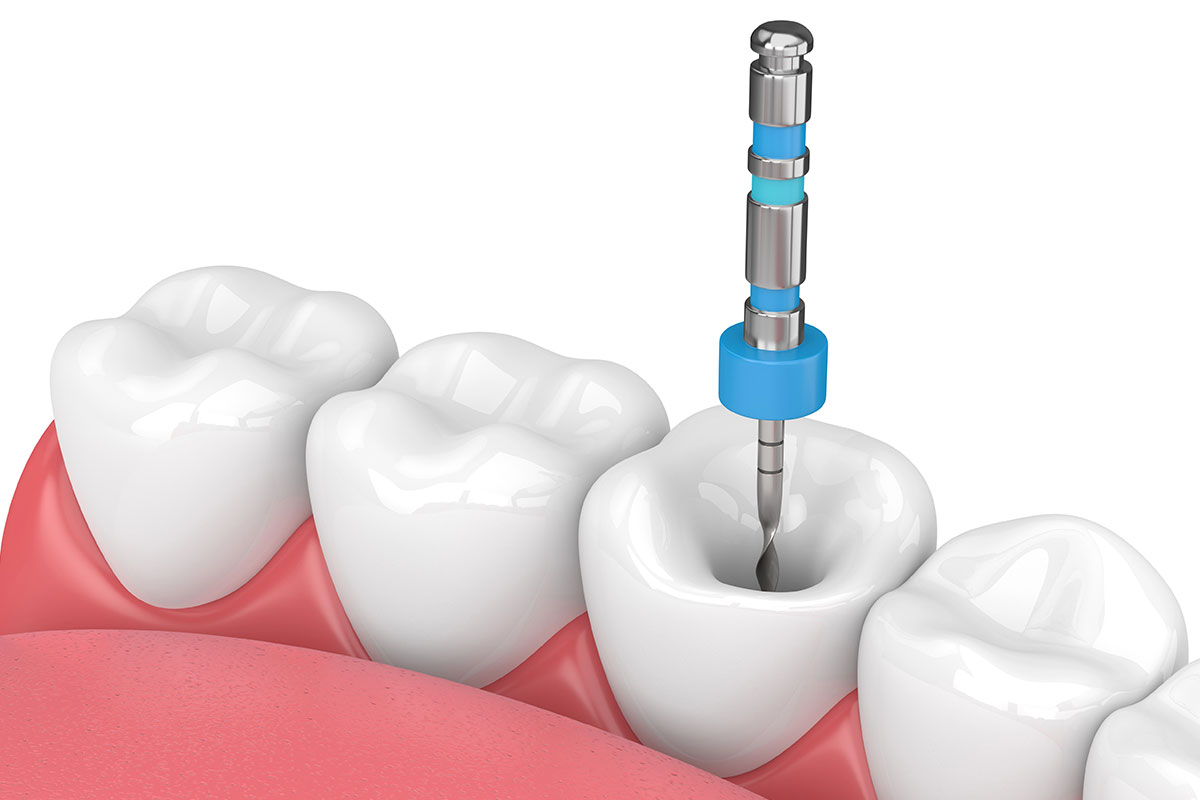 Endodontie Workshop